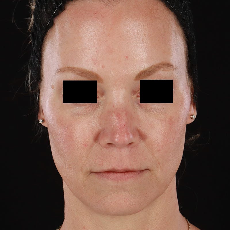 Dermal Fillers Before & After Gallery - Patient 179898170 - Image 1