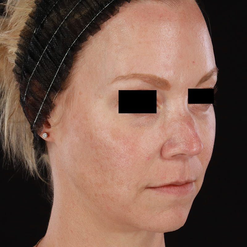 Dermal Fillers Before & After Gallery - Patient 179898170 - Image 3