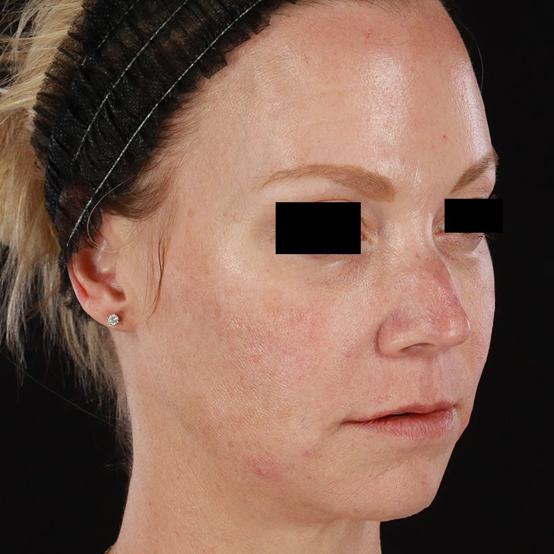 Dermal Fillers Before & After Gallery - Patient 179898170 - Image 4