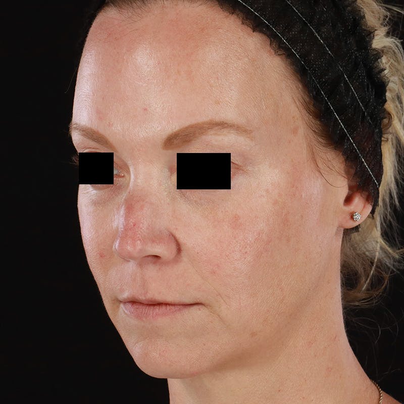 Dermal Fillers Before & After Gallery - Patient 179898170 - Image 5