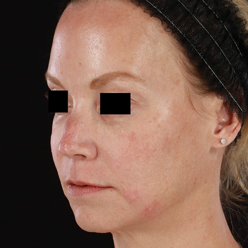 Dermal Fillers Before & After Gallery - Patient 179898170 - Image 6