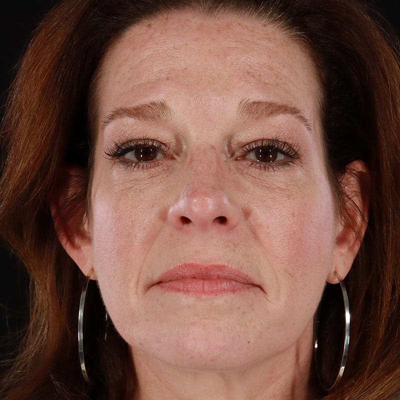 Dermal Fillers Before & After Gallery - Patient 179898174 - Image 2