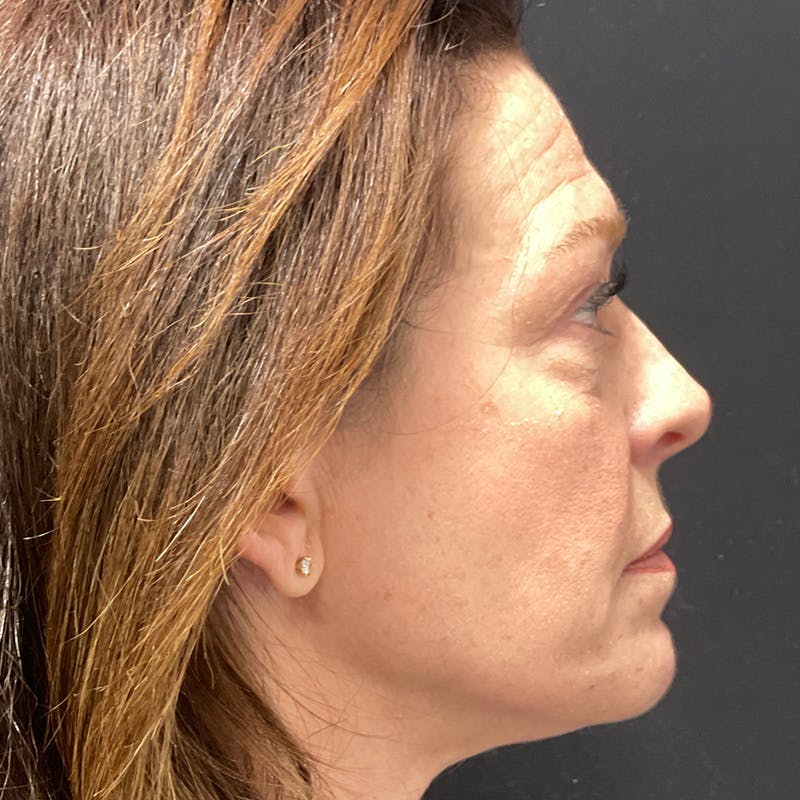 Dermal Fillers Before & After Gallery - Patient 179898174 - Image 5