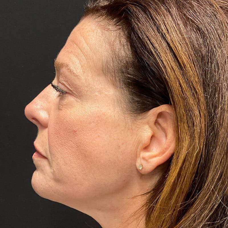 Dermal Fillers Before & After Gallery - Patient 179898174 - Image 9