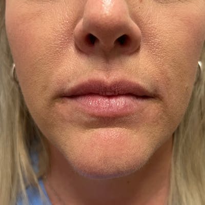 Dermal Fillers Before & After Gallery - Patient 179898195 - Image 1