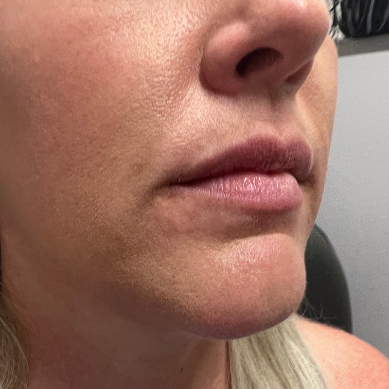Dermal Fillers Before & After Gallery - Patient 179898195 - Image 3