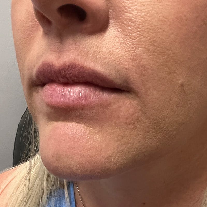 Dermal Fillers Before & After Gallery - Patient 179898195 - Image 5