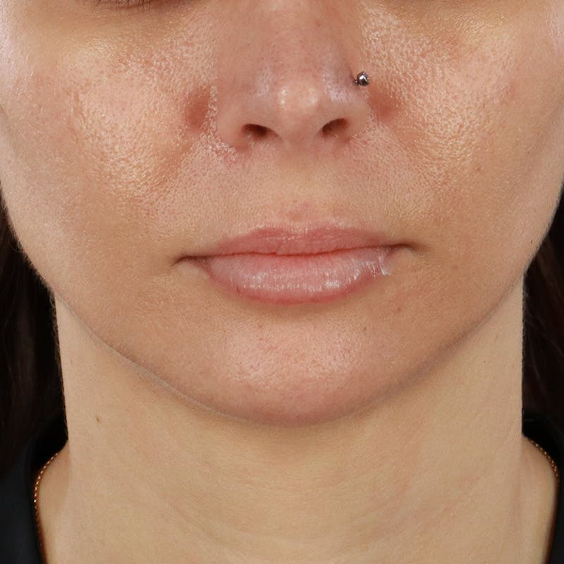 Dermal Fillers Before & After Gallery - Patient 179898215 - Image 1