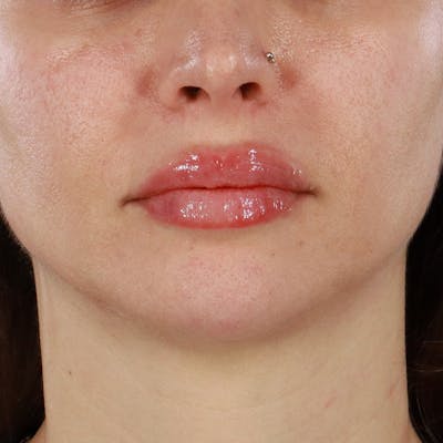 Dermal Fillers Before & After Gallery - Patient 179898215 - Image 2