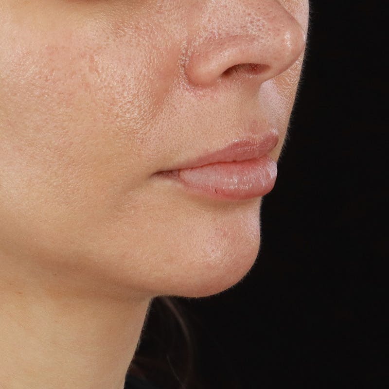 Dermal Fillers Before & After Gallery - Patient 179898215 - Image 3