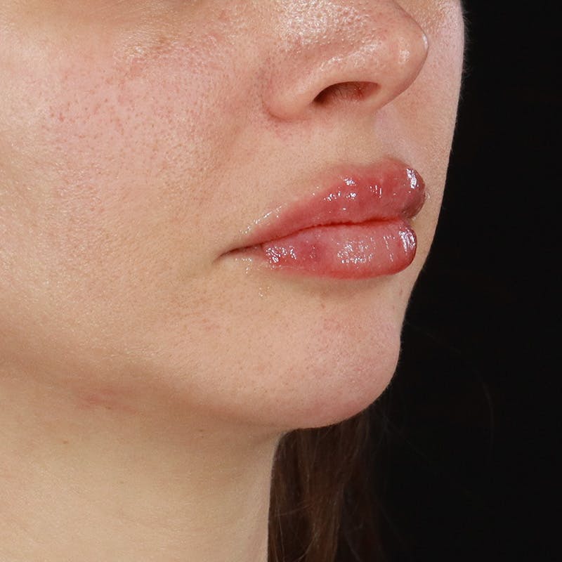 Dermal Fillers Before & After Gallery - Patient 179898215 - Image 4