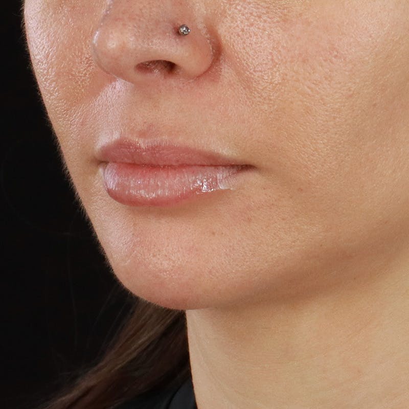 Dermal Fillers Before & After Gallery - Patient 179898215 - Image 5