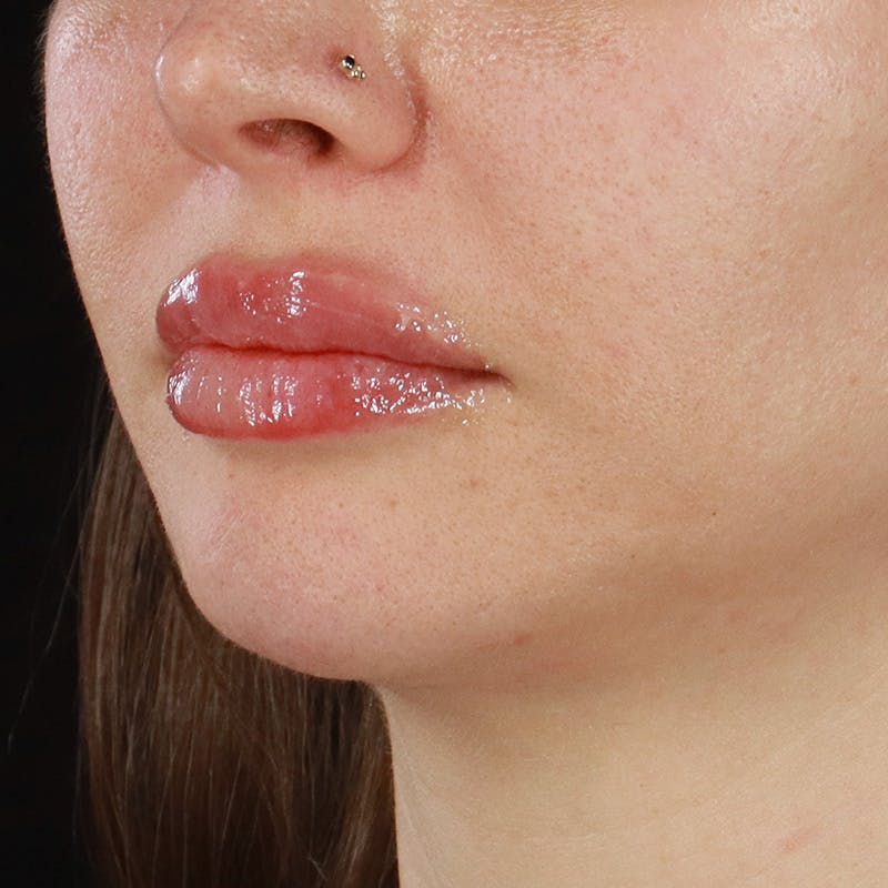 Dermal Fillers Before & After Gallery - Patient 179898215 - Image 6