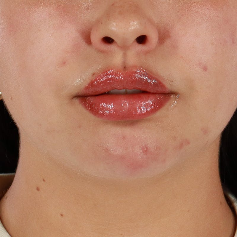Dermal Fillers Before & After Gallery - Patient 179898228 - Image 2