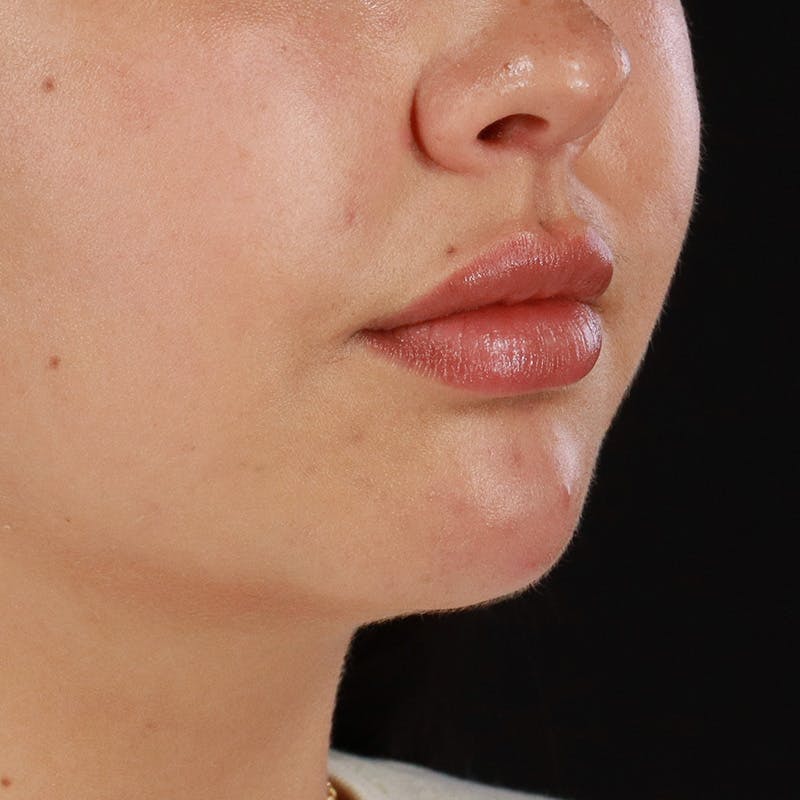 Dermal Fillers Before & After Gallery - Patient 179898228 - Image 3