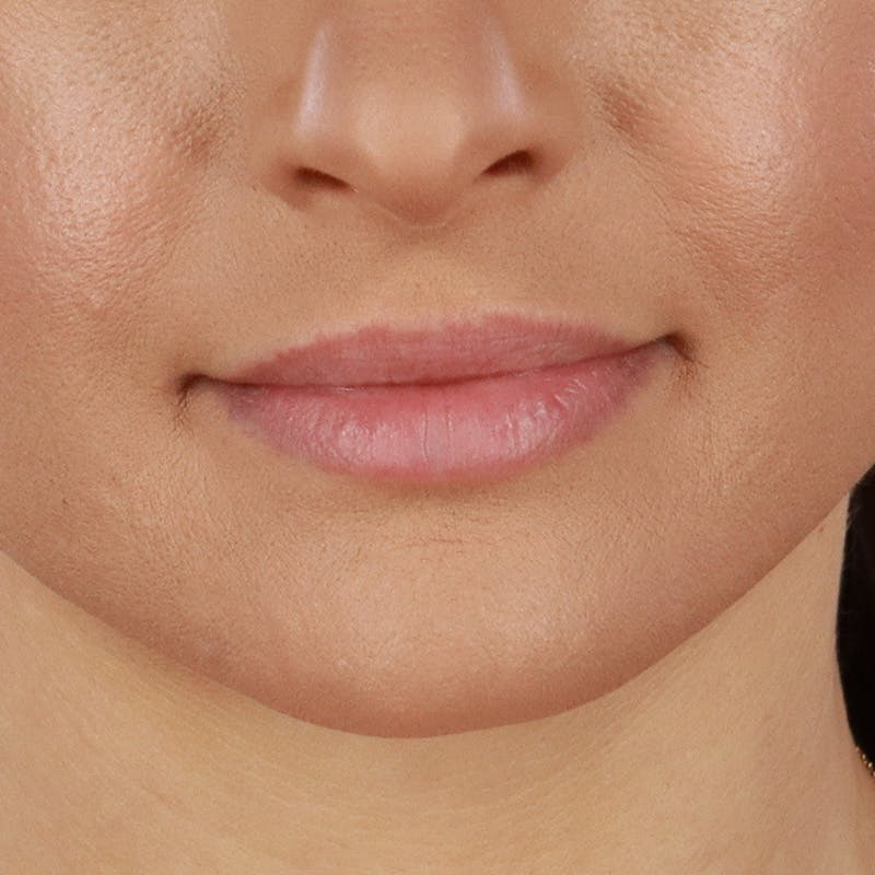 Dermal Fillers Before & After Gallery - Patient 179898433 - Image 1