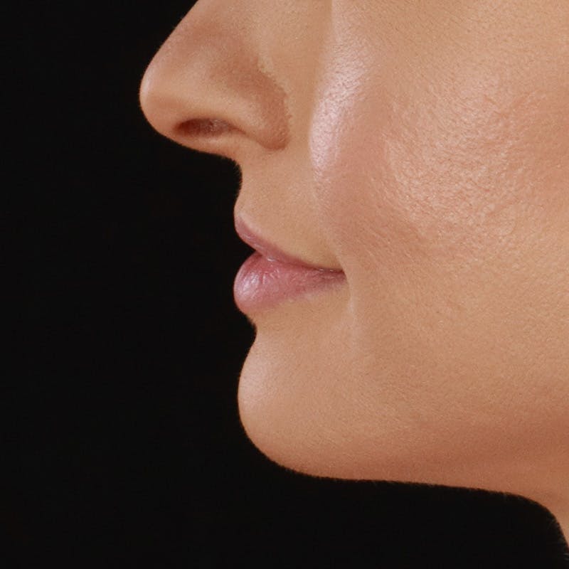 Dermal Fillers Before & After Gallery - Patient 179898433 - Image 9