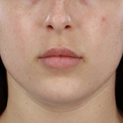 Dermal Fillers Before & After Gallery - Patient 179898445 - Image 1