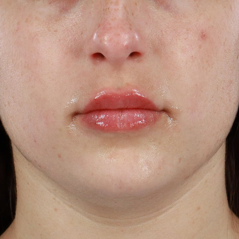 Dermal Fillers Before & After Gallery - Patient 179898445 - Image 2