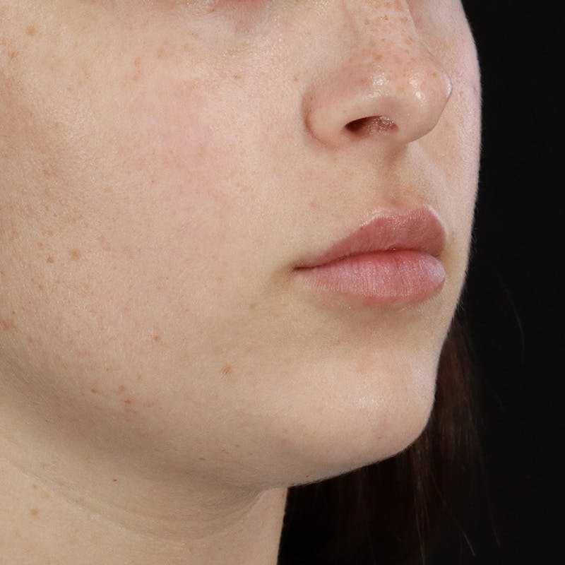 Dermal Fillers Before & After Gallery - Patient 179898445 - Image 3