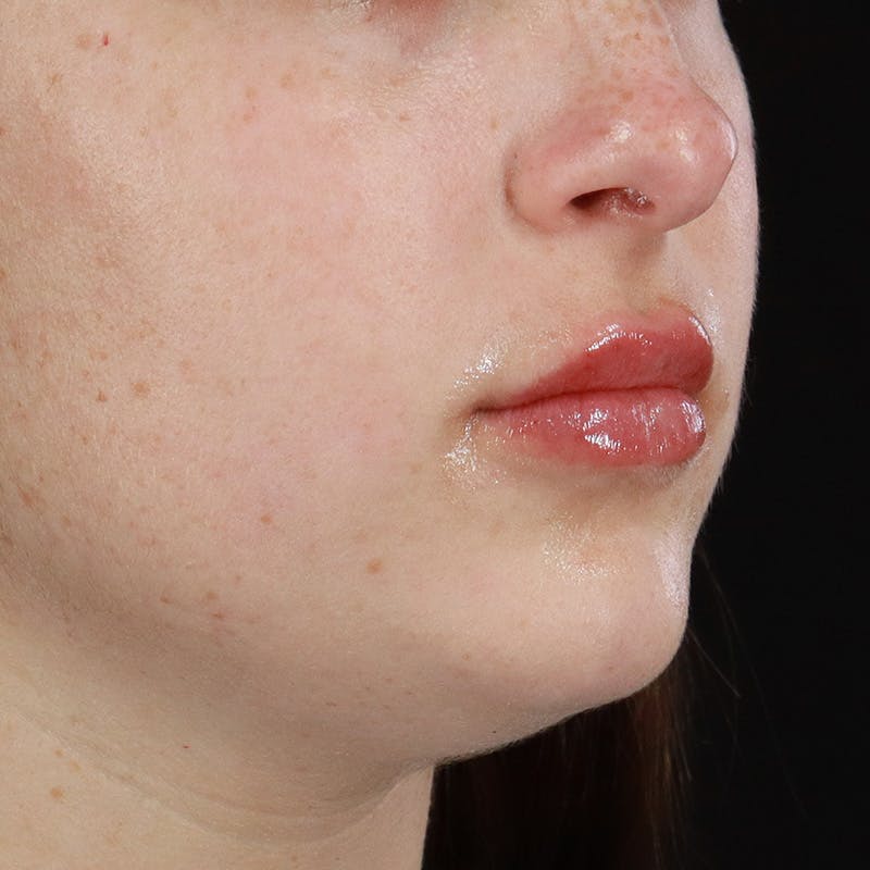 Dermal Fillers Before & After Gallery - Patient 179898445 - Image 4