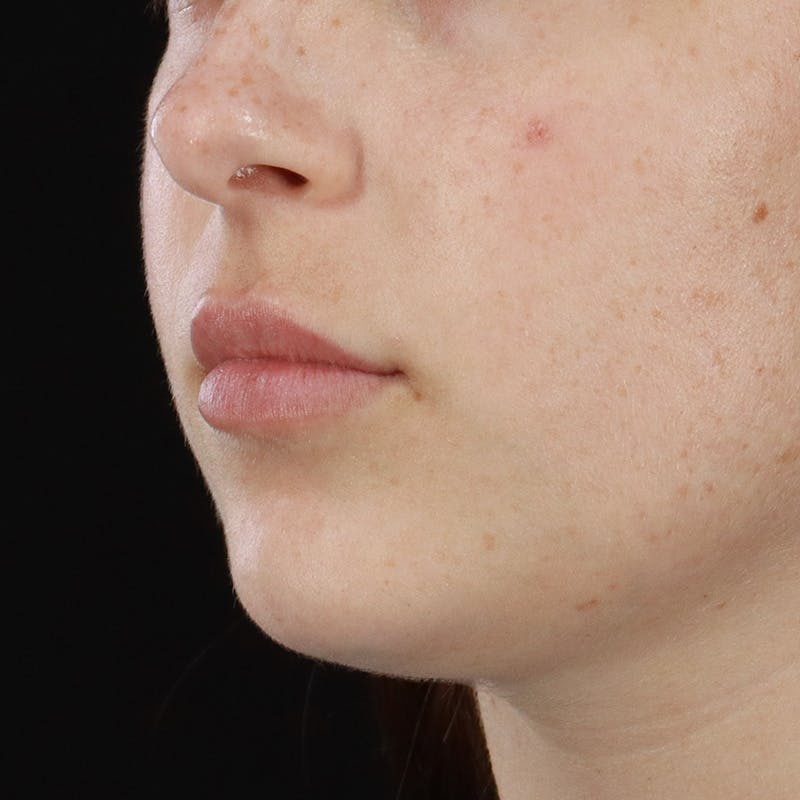 Dermal Fillers Before & After Gallery - Patient 179898445 - Image 5