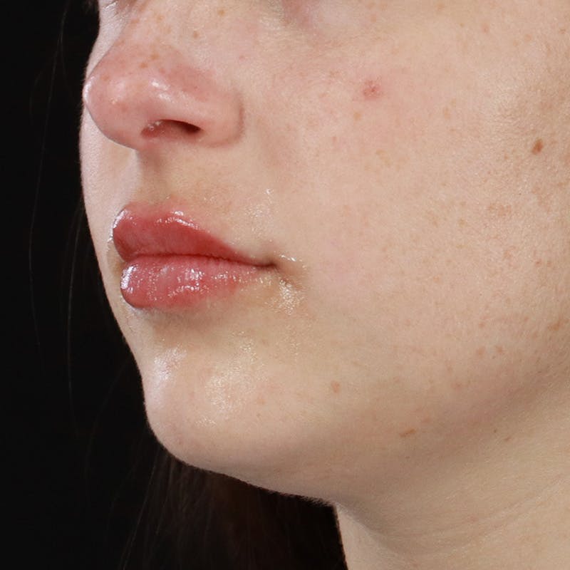 Dermal Fillers Before & After Gallery - Patient 179898445 - Image 6
