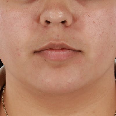 Dermal Fillers Before & After Gallery - Patient 179898489 - Image 1