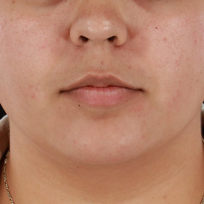 Dermal Fillers Before & After Gallery - Patient 179898489 - Image 1