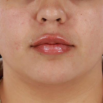 Dermal Fillers Before & After Gallery - Patient 179898489 - Image 2