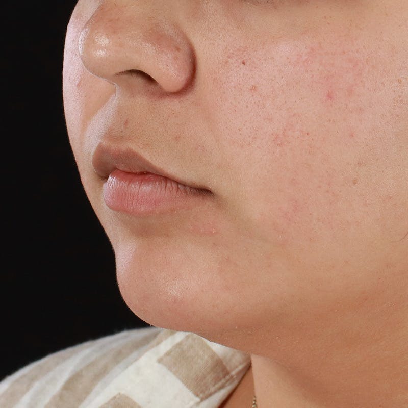 Dermal Fillers Before & After Gallery - Patient 179898489 - Image 5