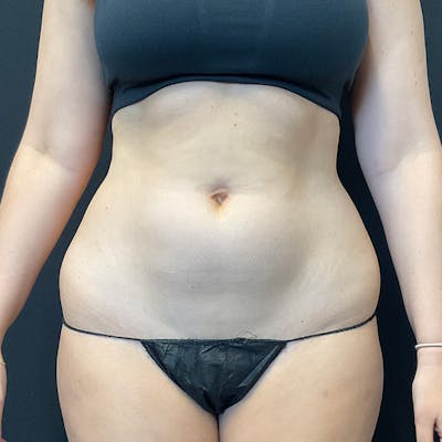 Liposuction Before & After Gallery - Patient 179897967 - Image 1