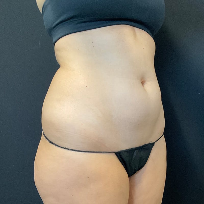 Liposuction Before & After Gallery - Patient 179897967 - Image 3