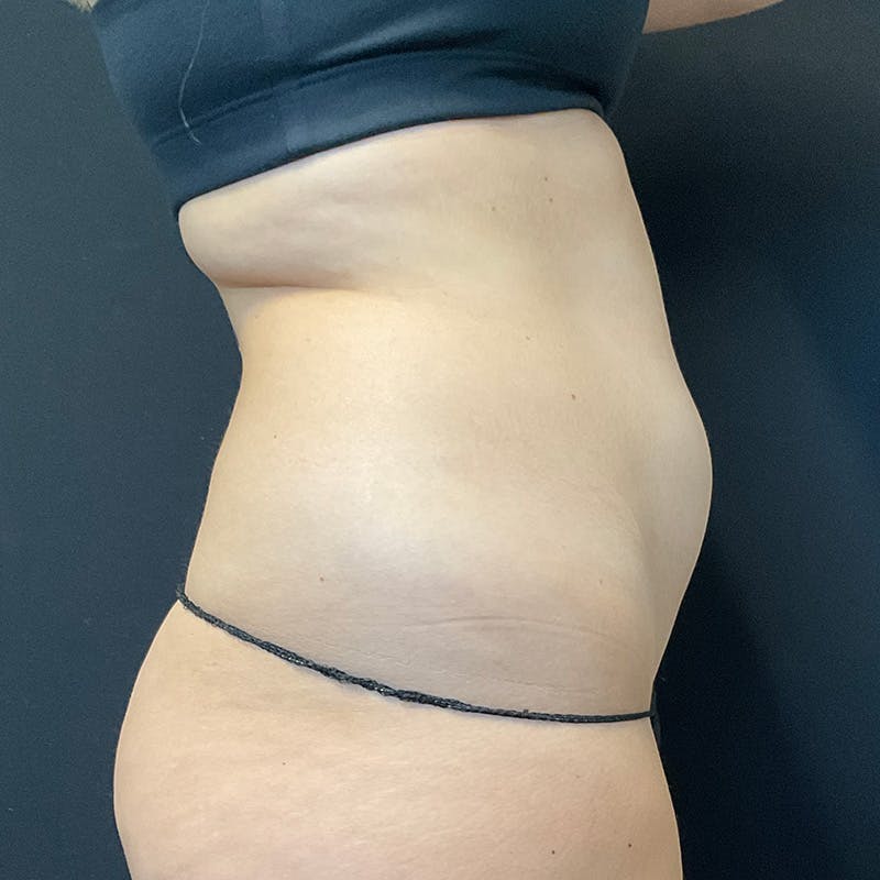 Liposuction Before & After Gallery - Patient 179897967 - Image 5