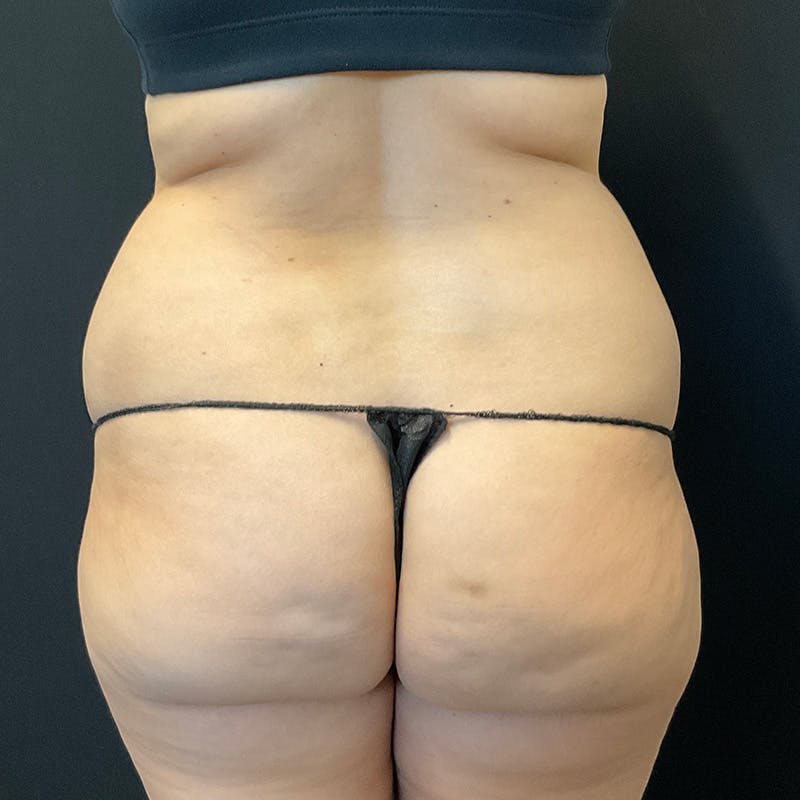 Liposuction Before & After Gallery - Patient 179897967 - Image 7