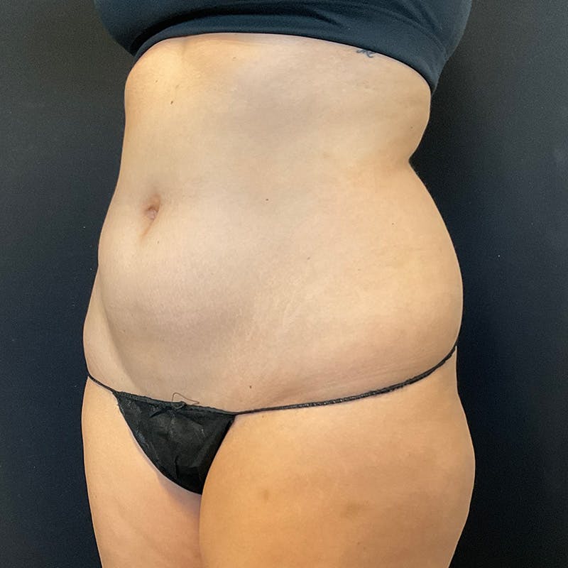 Liposuction Before & After Gallery - Patient 179897967 - Image 9