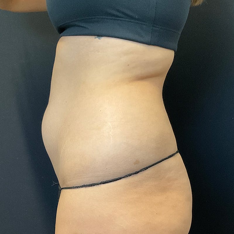 Liposuction Before & After Gallery - Patient 179897967 - Image 11