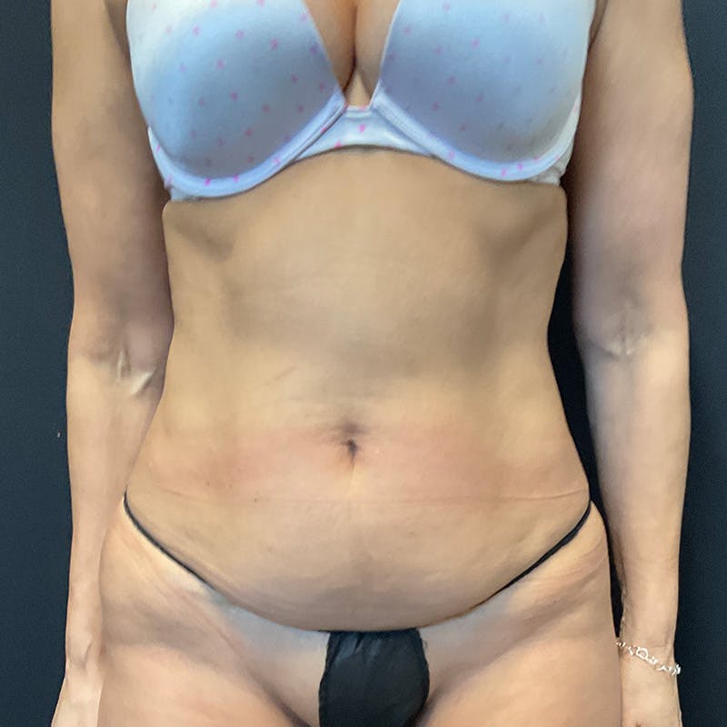 Liposuction Before & After Gallery - Patient 179897992 - Image 1