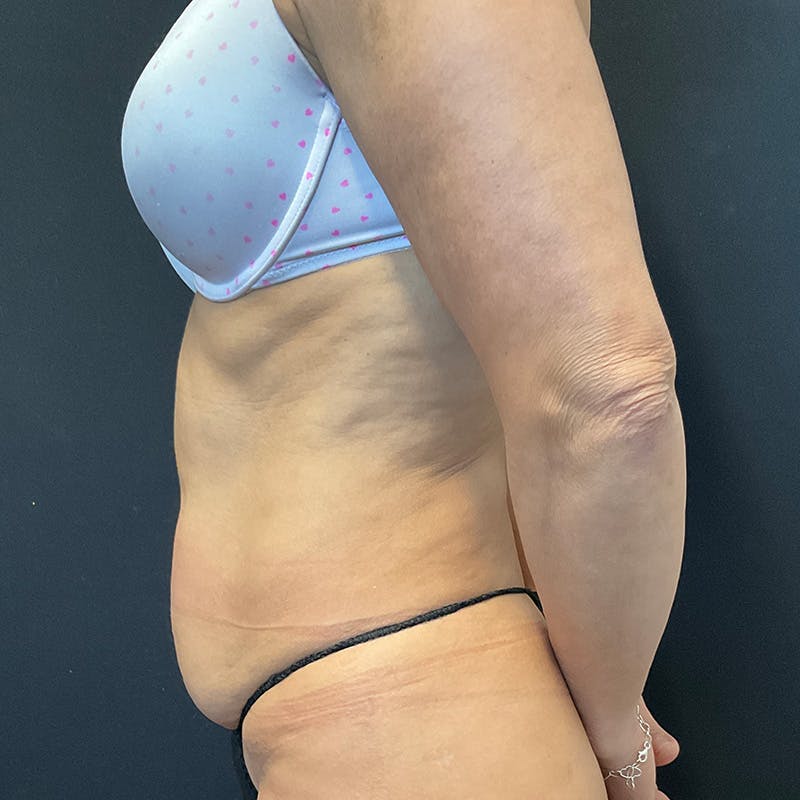 Liposuction Before & After Gallery - Patient 179897992 - Image 9