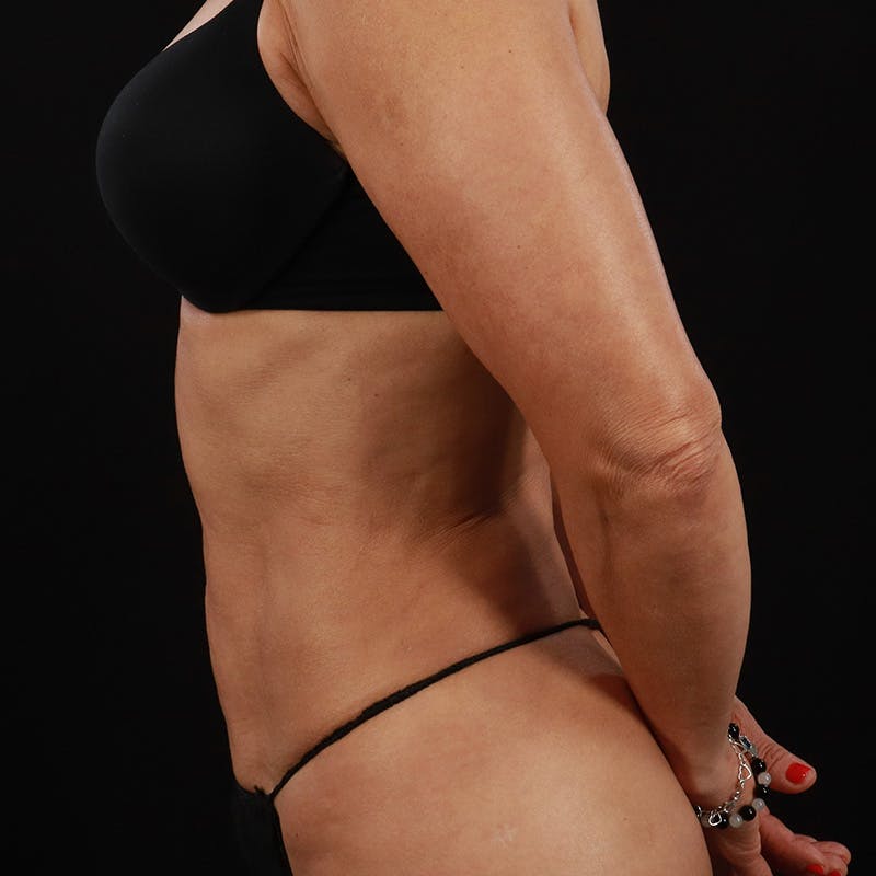 Liposuction Before & After Gallery - Patient 179897992 - Image 10