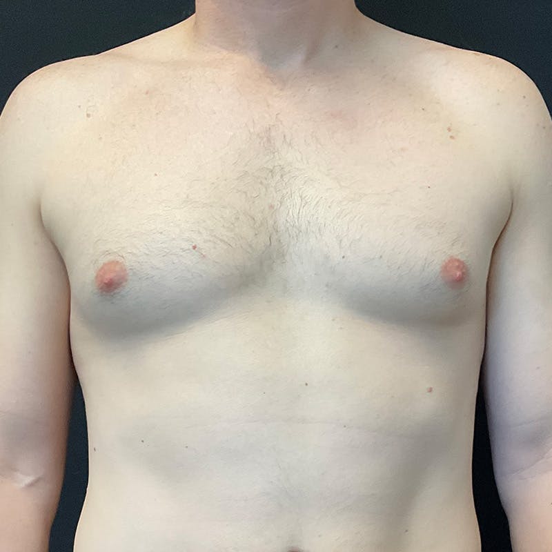 Gynecomastia Before & After Gallery - Patient 156786 - Image 1