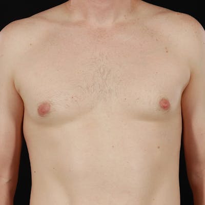 Gynecomastia Before & After Gallery - Patient 156786 - Image 2