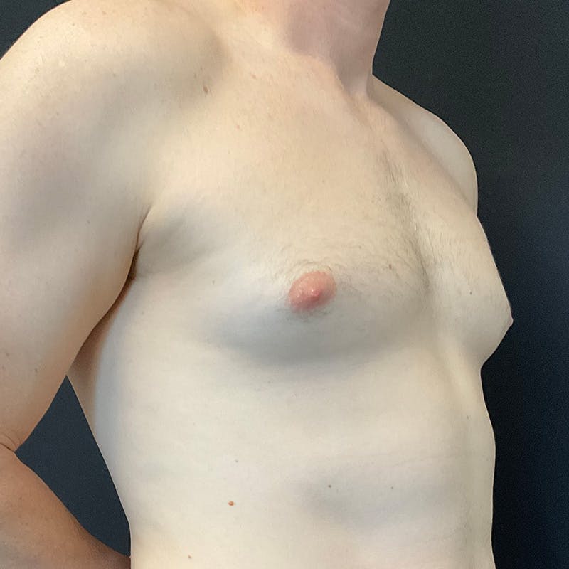 Gynecomastia Before & After Gallery - Patient 156786 - Image 3