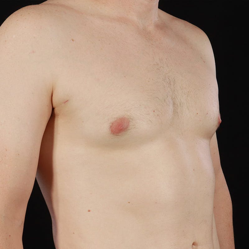 Gynecomastia Before & After Gallery - Patient 156786 - Image 4