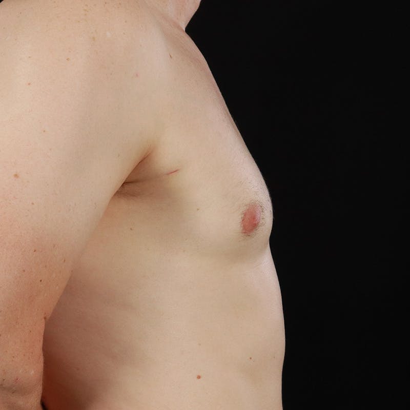 Gynecomastia Before & After Gallery - Patient 156786 - Image 6