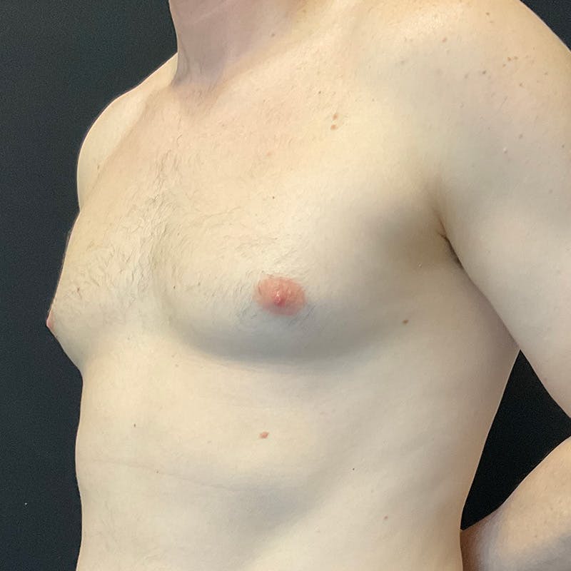 Gynecomastia Before & After Gallery - Patient 156786 - Image 7
