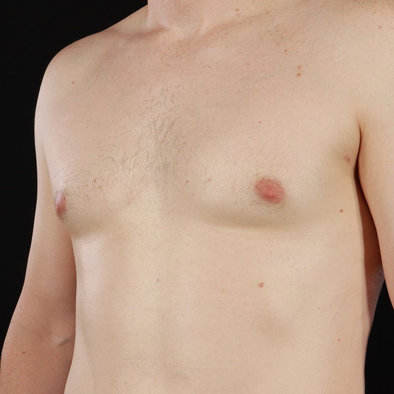 Gynecomastia Before & After Gallery - Patient 156786 - Image 8