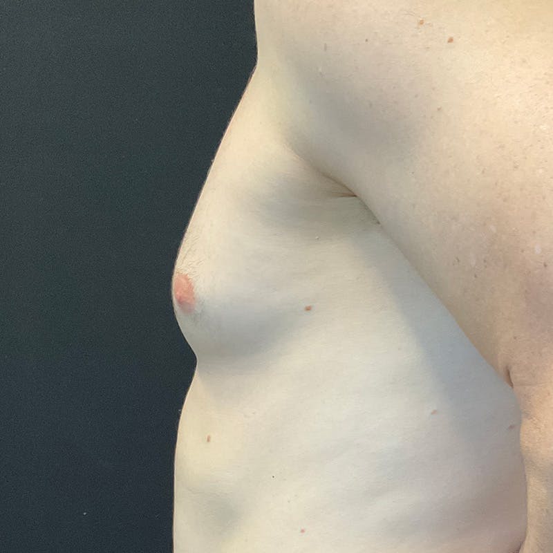 Gynecomastia Before & After Gallery - Patient 156786 - Image 9