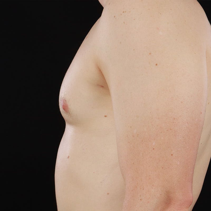 Gynecomastia Before & After Gallery - Patient 156786 - Image 10