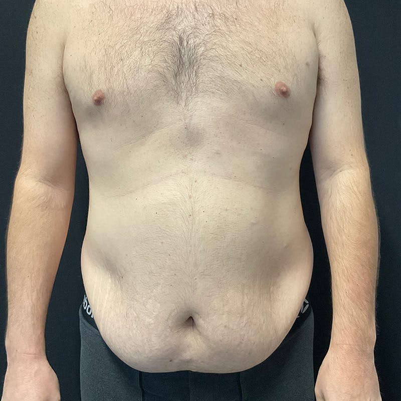 Abdominoplasty (Tummy Tuck) Before & After Gallery - Patient 179898045 - Image 1